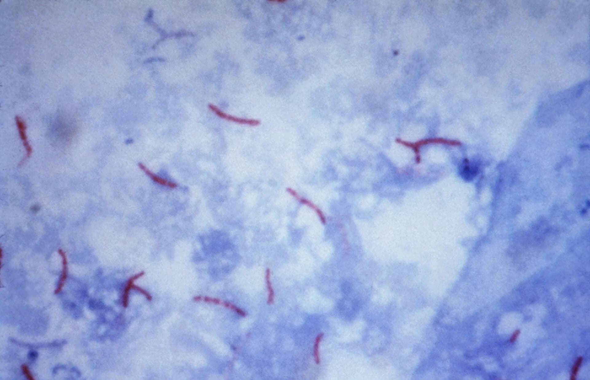 TB bacteria stained red under a microscope