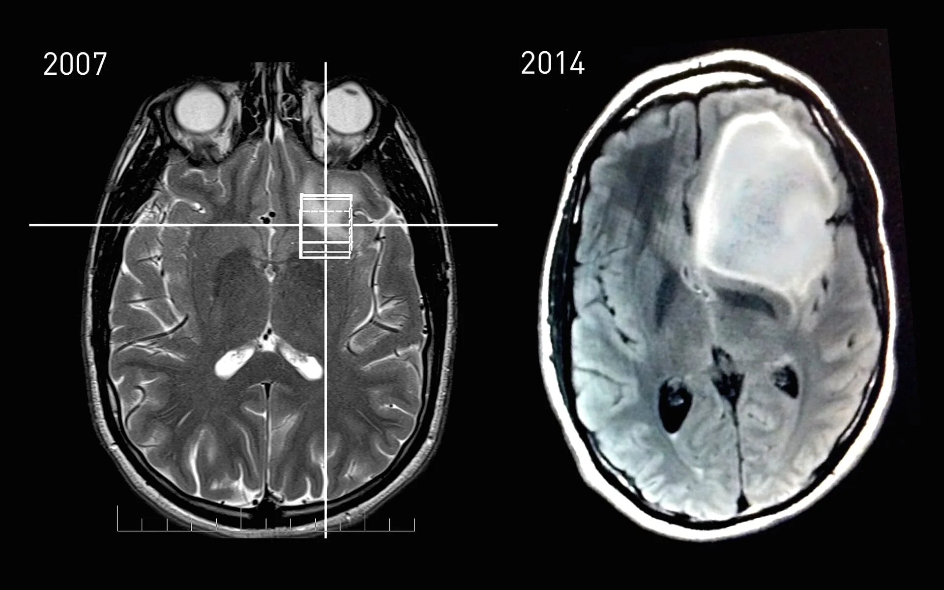 MRI scans of the brain shown side by side